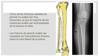 • Como tal las fracturas aisladas de
peroné no suelen ser muy
frecuentes ya que la mayoría de las
ocasiones suelen ser acompañadas
de la fractura de tibia.
• Las fractura de peroné suelen ser
causadas por traumatismos directos
sobre la cara lateral de la pierna.
 