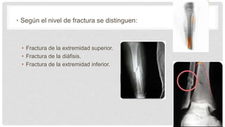 • Según el nivel de fractura se distinguen:
• Fractura de la extremidad superior.
• Fractura de la diáfisis.
• Fractura de la extremidad inferior.
 