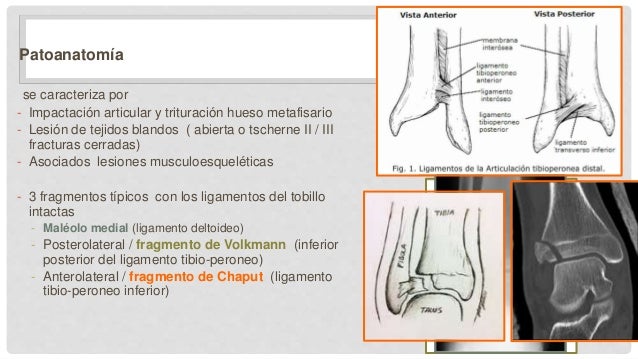 Fracturas de pierna