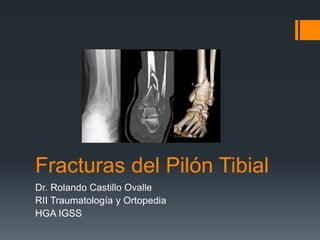 Fracturas del Pilón Tibial
Dr. Rolando Castillo Ovalle
RII Traumatología y Ortopedia
HGA IGSS
 