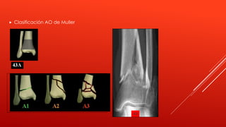 Fracturas de pilon tibial | PPTX