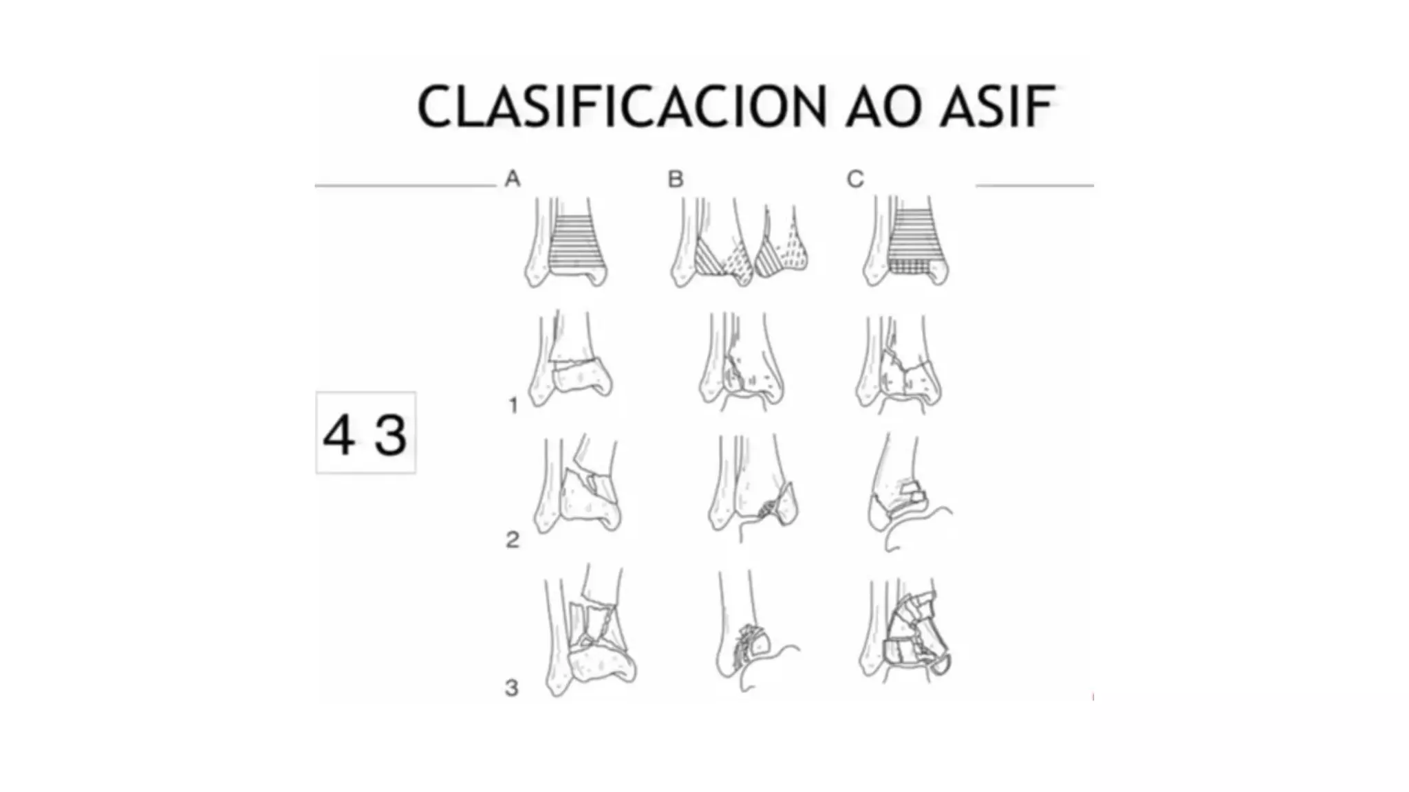 Fracturas de pilon tibial 2020 | PPT