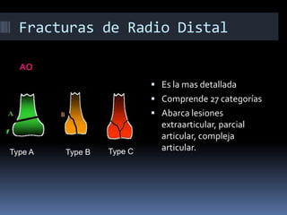 Fracturas de Radio DistalTipo 1 Diáfisis radialTipo 2 Estiloides radialTipo 3 Fragmento volar cubitalTipo 4 Fragmento dorsal cubitalMeloneSe basa en la columna de la superficie medial del radio distalPrimeras en describir el paso y extensión del trazo de fractura a través de la superficie articular.Útil solo en fracturas intraarticularesDesplazamiento, grado de conminucion, extensión a la diáfisis.