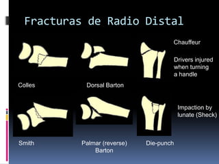 Fracturas de Radio DistalJupiter y FernándezModificación de la clasificación AOMecanismo de lesión, carga axial, compresión y avulsiónIncluye fracturas por avulsión causadas por luxación radiocarpalLesiones por alta velocidad
