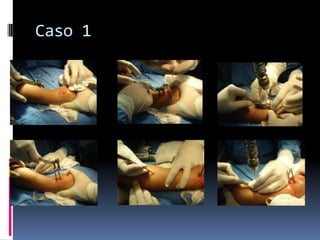 Fracturas de Radio DistalConclusión	La reducción abierta y fijación interna con placas puede permitir mayor precisión en la restauración de la superficie articular pero puede afectar la función postoperatoria.	Se requieren mas estudios siguiendo las bases de medicina basada en evidencia.