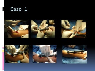 Fracturas de Radio DistalCaso 1Femenino de 50 años de edadAma de casaDiestra