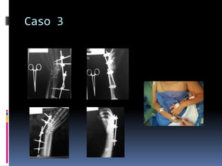 Herida por arma de fuego muñeca  izquierdaCaso 2