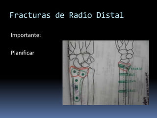 Caso 26 semanas después…Caso 3Femenino de 51 años