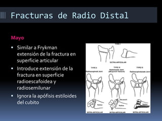 En fibrocartilago triangular se extiende la superfice medial del radio hasta la estiloides del cúbitoFracturas de Radio DistalClasificaciónFrykmanMayo MeloneJupiter y FernándezAO  