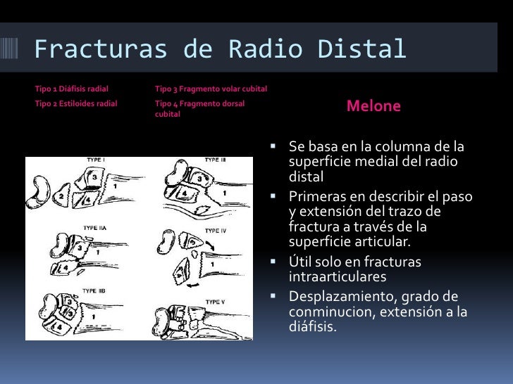 Fracturas de radio distal - Generalidades Fracturas de radio distal - Generalidades