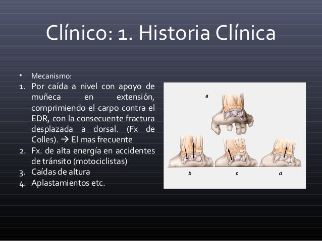 Fracturas de Radio Distal