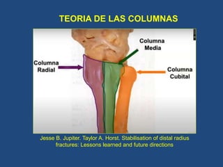 FRACTURAS DE RADIO DISTAL PÁEZ.pptx