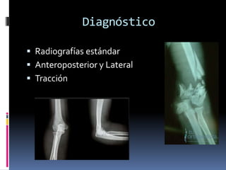 Diagnóstico
 Radiografías estándar
 Anteroposterior y Lateral
 Tracción
 