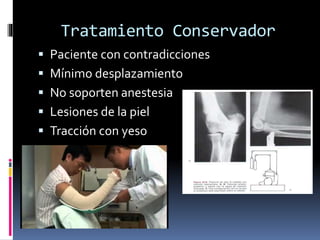 Tratamiento Conservador
 Paciente con contradicciones
 Mínimo desplazamiento
 No soporten anestesia
 Lesiones de la piel
 Tracción con yeso
 