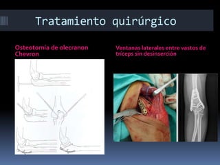 Tratamiento quirúrgico
Osteotomía de olecranon
Chevron
Ventanas laterales entre vastos de
tríceps sin desinserción
 