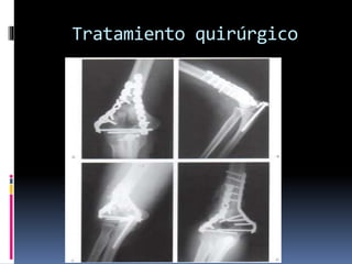 Tratamiento quirúrgico
 