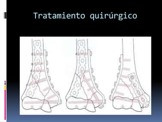 Tratamiento quirúrgico
 