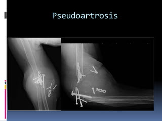 Pseudoartrosis
 