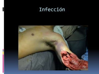 Infección
 