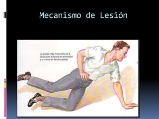 Mecanismo de Lesión
 