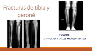 Fracturas de tibia y
peroné
PONENTE:
MIP PERAZA PERALES MICHELLE NATALY
 