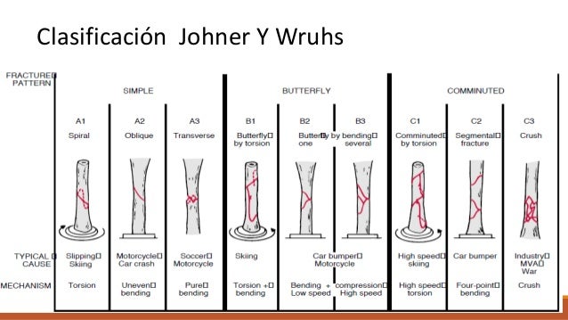 Fracturas de tibia y perone