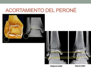 ACORTAMIENTO DEL PERONÉ
 