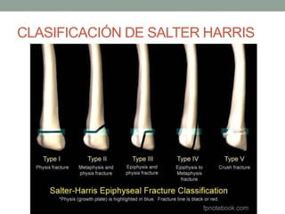 CLASIFICACIÓN DE SALTER HARRIS
 