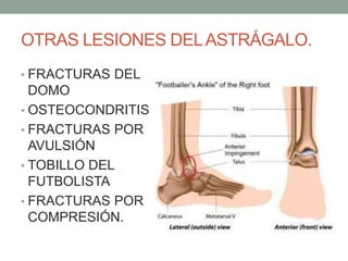 OTRAS LESIONES DELASTRÁGALO.
• FRACTURAS DEL
DOMO
• OSTEOCONDRITIS
• FRACTURAS POR
AVULSIÓN
• TOBILLO DEL
FUTBOLISTA
• FRACTURAS POR
COMPRESIÓN.
 