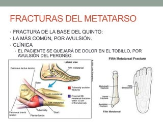FRACTURAS DEL METATARSO
• FRACTURA DE LA BASE DEL QUINTO:
• LA MÁS COMÚN, POR AVULSIÓN.
• CLÍNICA
• EL PACIENTE SE QUEJARÁ DE DOLOR EN EL TOBILLO, POR
AVULSIÓN DEL PERONÉO.
 