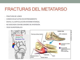 FRACTURAS DEL METATARSO
• FRACTURA DE JONES
• COMÚN EN ALTLETAS EN ENTRENAMIENTO
• DISTAL A LA ARTICULACIÓN INTERMETATARSAL
• NO ASOCIADA CON MECANISMO DE INVERSIÓN.
• YESO SUROPODÁLICO
 
