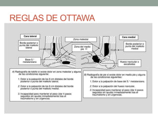 REGLAS DE OTTAWA
 