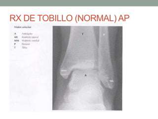 RX DE TOBILLO (NORMAL) AP
 