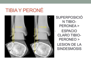 TIBIAY PERONÉ
• SUPERPOSICIÓ
N TIBIO-
PERONEA >
• ESPACIO
CLARO TIBIO-
PERONEO >
• LESION DE LA
SINDESMOSIS
 