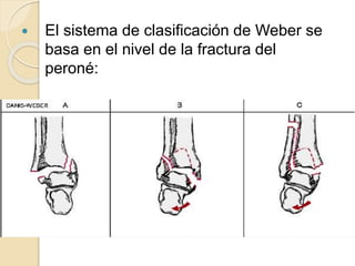  El sistema de clasificación de Weber se
basa en el nivel de la fractura del
peroné:
 