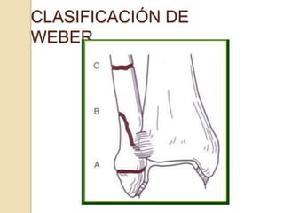 CLASIFICACIÓN DE
WEBER
 