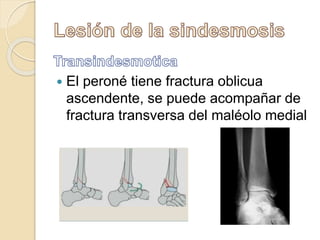  El peroné tiene fractura oblicua
ascendente, se puede acompañar de
fractura transversa del maléolo medial
 