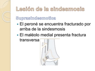  El peroné se encuentra fracturado por
arriba de la sindesmosis
 El maléolo medial presenta fractura
transversa
 