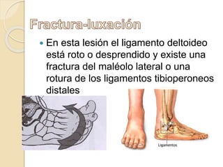  En esta lesión el ligamento deltoideo
está roto o desprendido y existe una
fractura del maléolo lateral o una
rotura de los ligamentos tibioperoneos
distales
 