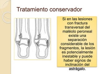 Tratamiento conservador
Si en las lesiones
con fractura
transversal del
maléolo peroneal
existe una
separación
considerable de los
fragmentos, la lesión
es potencialmente
inestable y puede
haber signos de
inclinación del
astrágalo.
 