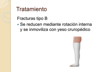 Tratamiento
Fracturas tipo B
 Se reducen mediante rotación interna
y se inmoviliza con yeso cruropédico
 