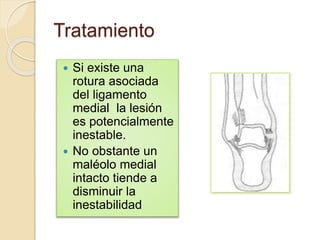 Tratamiento
 Si existe una
rotura asociada
del ligamento
medial la lesión
es potencialmente
inestable.
 No obstante un
maléolo medial
intacto tiende a
disminuir la
inestabilidad
 