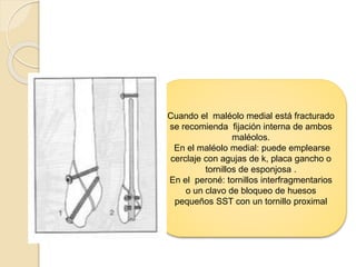 Cuando el maléolo medial está fracturado
se recomienda fijación interna de ambos
maléolos.
En el maléolo medial: puede emplearse
cerclaje con agujas de k, placa gancho o
tornillos de esponjosa .
En el peroné: tornillos interfragmentarios
o un clavo de bloqueo de huesos
pequeños SST con un tornillo proximal
 