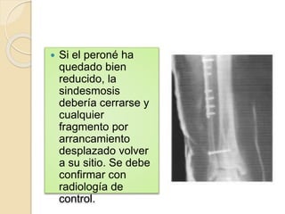  Si el peroné ha
quedado bien
reducido, la
sindesmosis
debería cerrarse y
cualquier
fragmento por
arrancamiento
desplazado volver
a su sitio. Se debe
confirmar con
radiología de
control.
 