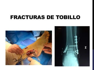 FRACTURAS DE TOBILLO
 