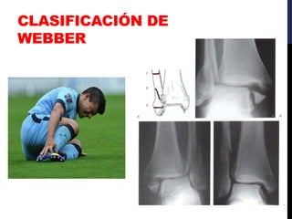 CLASIFICACIÓN DE
WEBBER
 
