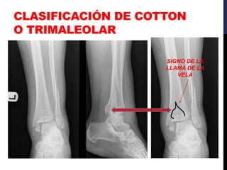 CLASIFICACIÓN DE COTTON
O TRIMALEOLAR
SIGNO DE LA
LLAMA DE LA
VELA
 