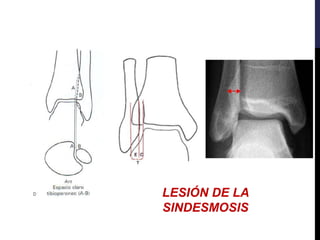 LESIÓN DE LA
SINDESMOSIS