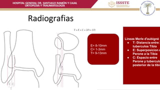Fracturas de Tobillo.pptx