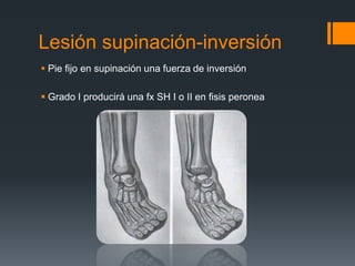 Lesión supinación-inversión
 Pie fijo en supinación una fuerza de inversión
 Grado I producirá una fx SH I o II en fisis peronea
 